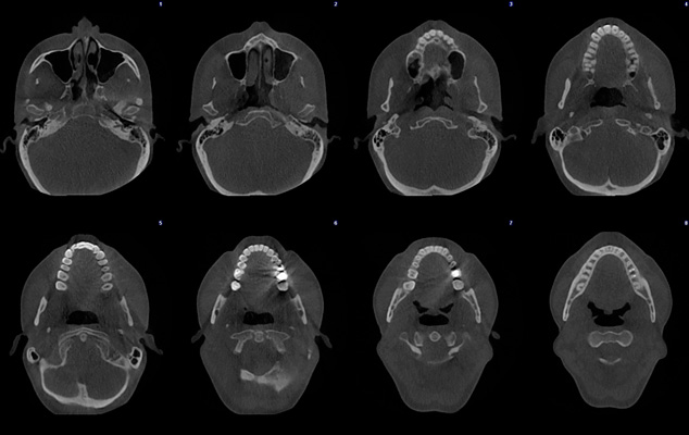 Planmeca Ultra Low Dose